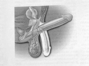 Dessin illustrant la pose d'implant pénien hydraulique