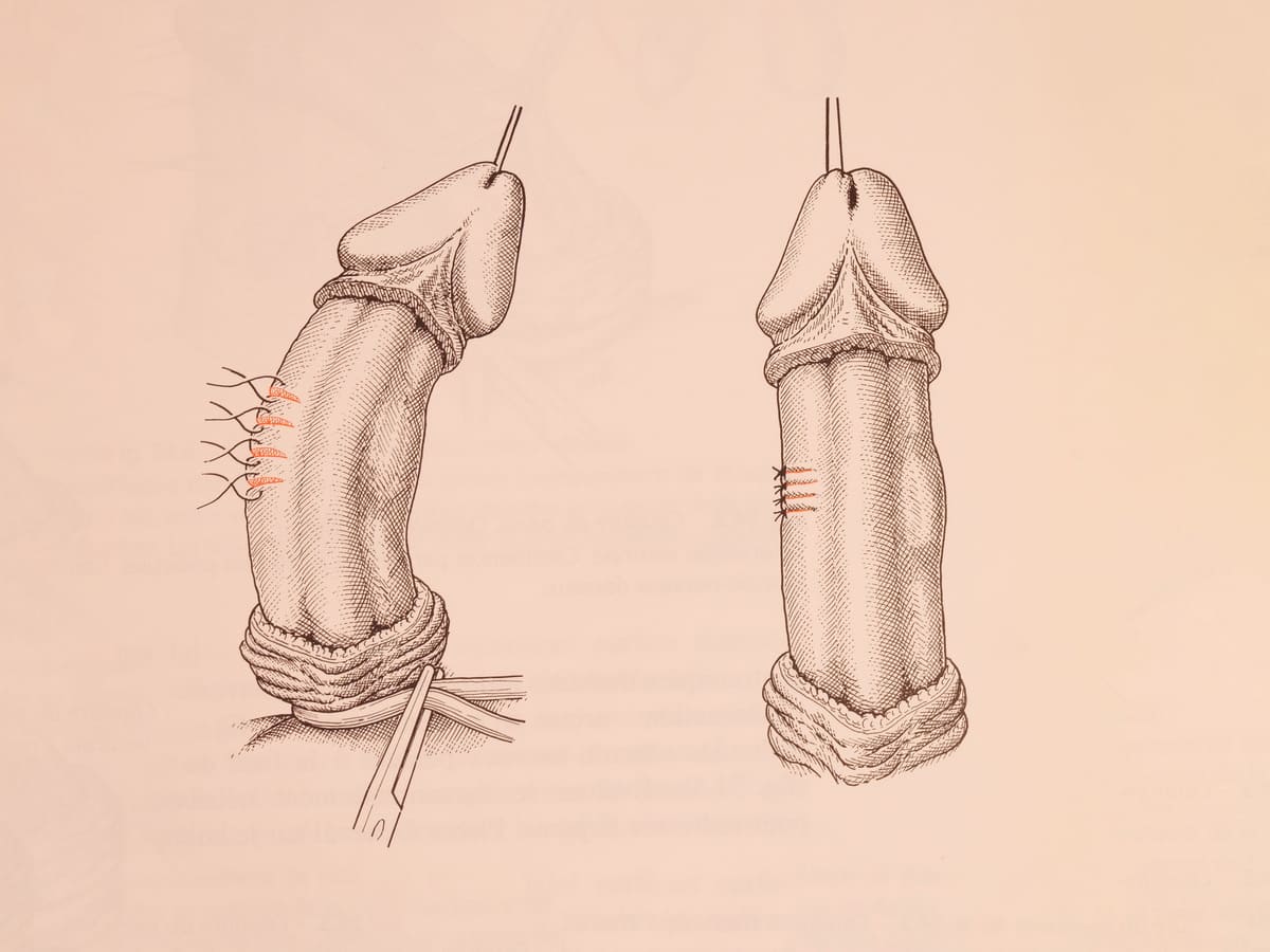 Dessin illustrant opération Lapeyronie