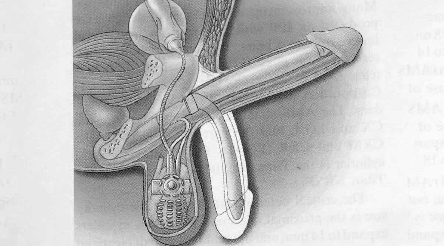 Dessin illustrant la pose d'implant pénien hydraulique