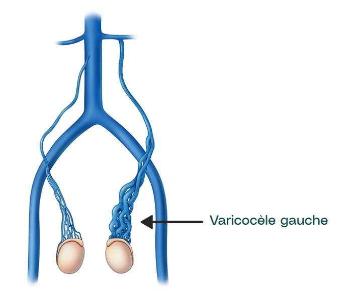Varicocele: Treatment by microsurgery – Dr. Davy Benarroche